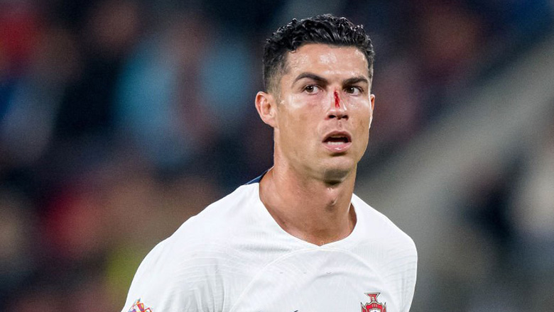 Ronaldo tới sân tập ĐT Bồ Đào Nha với mắt trái sưng bầm - Ảnh 2